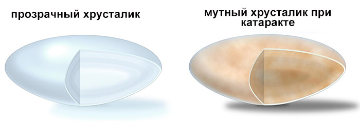 Утолщение и помутнение хрусталика при катаракте